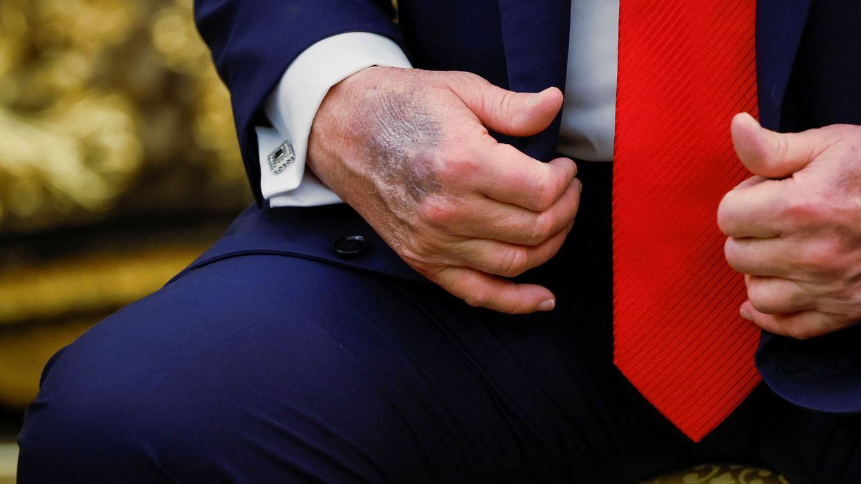 If Donald Trump’s skin gets any thinner, America will have its first translucent president