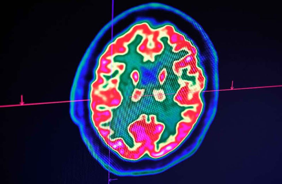 Confusion, seizure, strokes: How COVID-19 may affect the brain