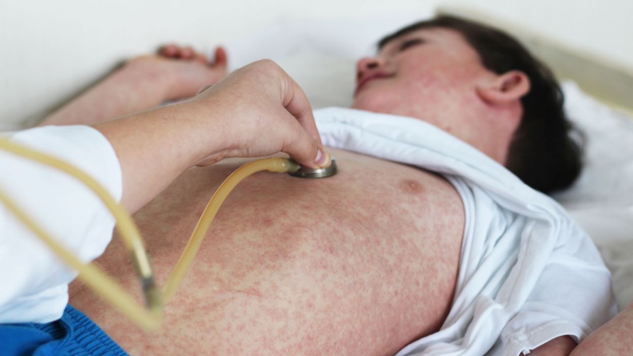 Kentucky officials fear measles outbreak after 'spiritual revival'