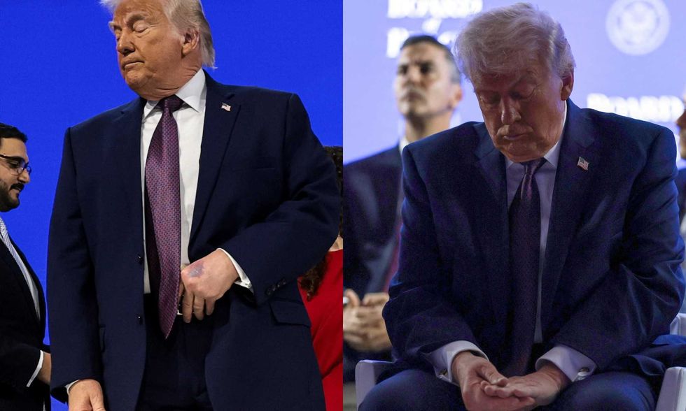 Bàn tay của Trump 'trông giống da tê giác' và vết bầm đã 'lan rộng': phóng viên báo cáo