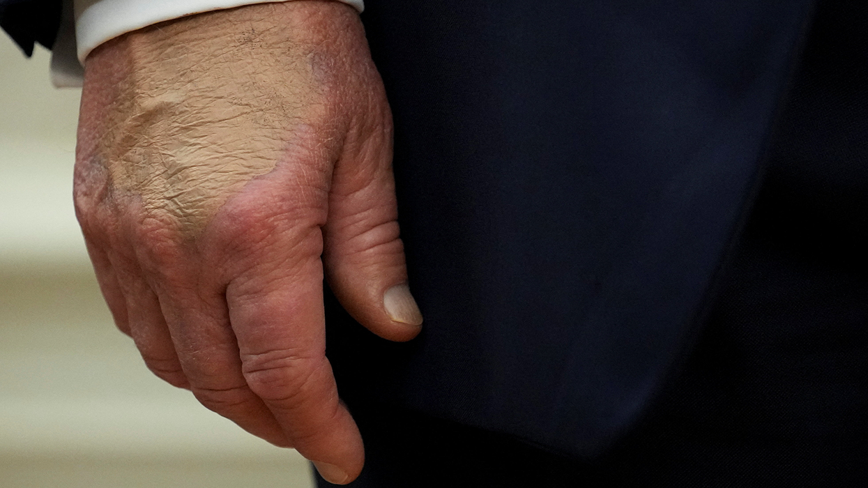 'Slurred speech and difficulty walking':Trump’s declining health sparks new conspiracy